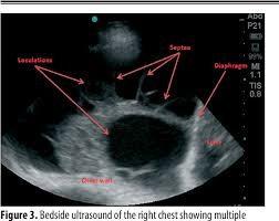 A narrative review from diagnosis to treatment. Figure 3 From Multiloculated Pleural Effusion Detected By Ultrasound Only In A Critically Ill Patient Semantic Scholar