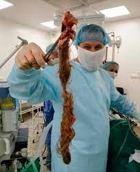 Maybe you would like to learn more about one of these? Doctors Remove Huge Hairball Growing Inside 30 Year Old Woman S Ovaries Since Birth World News Mirror Online