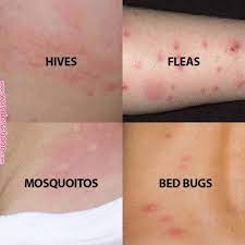 pin on health pin on health bug bites remedies itchy bug bites bed bug bites