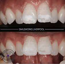 How do i get rid of white spots on teeth? White Marks On Teeth How To Remove Them Price Review Pictures