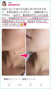 samamtha イボ 治療 イボ 除去 薬品