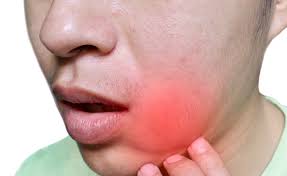 Another great advice on how to bring down swelling after wisdom teeth removal concerns salt water rinse. Face Cheek Swelling What To Do Next Melbourne Dentist In Malvern East