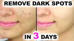 How to remove dark spots on the face? In 3 Days Remove Dark Spots Black Spots Acne Scars Anaysa Youtube