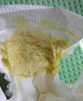 Adakah warna kotoran anak anda normal? Dr Siti Sarah Aishah Suhaidi On Twitter Biliary Atresia Penyakit Di Mana Sistem Biliary Dan Salur Dlm Hati Tersumbat Sejak Lahir Lagi Tanda Penyakit Biliary Atresia Ialah Masalah Kuning Ataupun Jaundis Yang