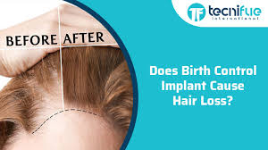Symptoms include intense itching (itch causes your cat to over groom or chew the fur), redness, scaly patches, and hair loss. Does Birth Implant Cause Hair Loss Tecnifue Best Hair Transplant