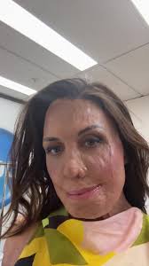 Turia Pitt Historia: Behind the Scenes at The Project Australia