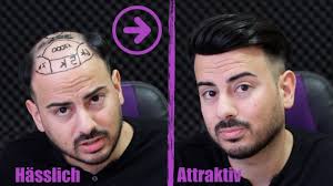 Schon die alten agypterinnen standen auf den knapp schulterlangen pagenschnitt. Haartransplantation Erfahrung 1 Monat Vorher Nachher 1900 Youtube