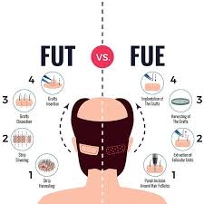 The Complete Guide To A Hair Transplant Procedure With Faqs Answered Hair Transplant Procedure Best Hair Transplant Hair Implants