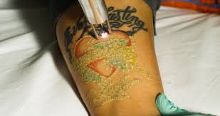 Established in 1999, name brand tattoo has earned the reputation of being a premier studio in the midwest for it's innovative, straight forward approach to traditional tattooing and is recognized by tattoo artists and collectors worldwide. Laser Tattoo Removal In Ann Arbor Michigan Astanza