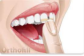 Taking Care Of Your Teeth Is Very Important It Is Important That You Remove Plaque Daily And Thoroughly From All Tooth Surfaces By B Gap Teeth Fix Teeth Teeth