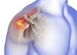 Image result for Rotator Cuff Rupture