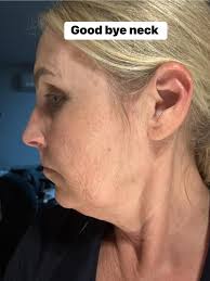 Hi friends. I had a breast reduction about 4 years back for medical  reasons. Now that I am done having kids I am not happy with my chest, or  the unnecessary scarring