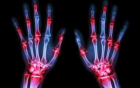 Ii) tak rasa panas isyarat tanda sakit lenguh (rheumatism). Sakit Sendi Punca Rawatan Dan Penyiasatan The Diagnosa