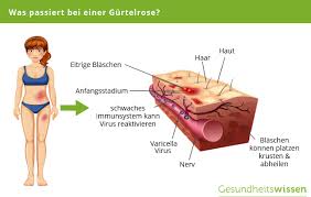 Gürtelrose (herpes zoster) tritt meistens in höherem lebensalter auf. Gurtelrose Ursache Symptome Diagnose Behandlung
