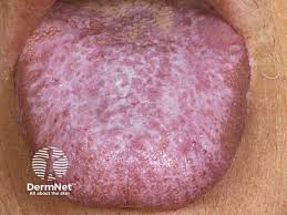 Image result for lichen planus on tongue)
