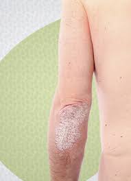 Os sintomas da psoríase não são os mesmos para todos os pacientes e não variam consideravelmente de acordo com o tipo de psoríase responsável. Psoriase Dra Jackeline Mota