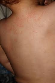 Astepaway New Search Experience Heat Rash Treatment Rashes