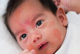 Image result for red rash face