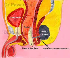 This occurs in up to 40% of patients with abscesses. Fistula In Ano