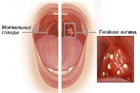 Gnojnaya Angina U Rebenka Stati