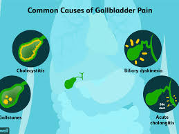 Gallstones begin with bile, a substance that helps with the digestion of fats and the symptoms arise mainly when stones pass through a bile duct or obstruct it, causing biliary colic unfortunately, stones are likely to recur after medical treatment. Gallbladder Pain Causes Treatment And When To See A Doctor
