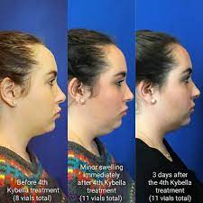 Pin On Kybella