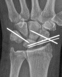 Image result for Scapholunate Dislocation