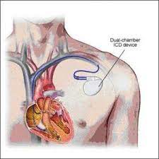 • interferencias con dispositivos eléctricos implantados. Apos Parada Cardiaca Eriksen Tera De Implantar Desfibrilador Interno Para Evitar Novos Episodios Tnt Sports