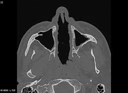 What is a deviated nasal septum (dns)? Nasal Septum Perforation Secondary To Granulomatosis With Polyangiitis Radiology Case Radiopaedia Org