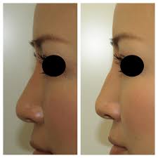 鼻レディエッセ注入｜神戸三宮で鼻レディエッセなら神成美容外科