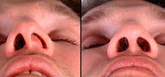 Maybe you would like to learn more about one of these? Deviated Septum And Weight Gain Rhinoplasty In Denver An Expert S Blog