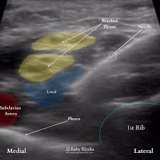 Image result for Superior Trunk Block