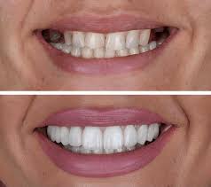 Dental Implants Before and After Results – Real Transformations