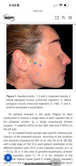 Neurologist for botox injections in jaw area?