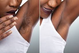 Located in the heart of downtown los angeles sculptdtla is downtown's premiere and best medical spa. Laser Hair Removal For All Skin Tones African American Skin Los Angeles