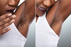We offer the best laser hair removal in los angeles. Laser Hair Removal For All Skin Tones African American Skin Los Angeles