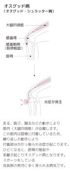 オスグッド 野球