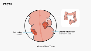 Position statement of the european society of gastrointestinal endoscopy (esge). Sessile Polyps Causes Risk Factors And Treatment