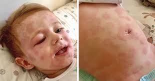 Quaddeln im Überblick