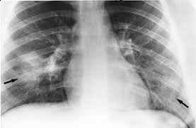 Sie kann akut oder chronisch verlaufen. Spectrum Of Clinical And Radiographic Findings In Pediatric Mycoplasma Pneumonia Radiographics