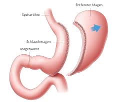 Clinic Sk Turkey Ubergewicht Chirurgische Methoden Schlauchmagen Opertion Gastrischer By Pass Mini Gastric By Pass Turkey Izmir Istanbul