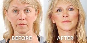 It is most common in asians. Best Epicanthoplasty Los Angeles Dr Kenneth Kim