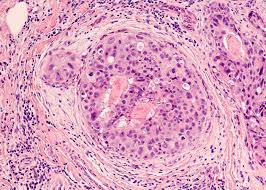 Gdf11 Protein Found To Inactivate Triple Negative Breast Cancer Cells
