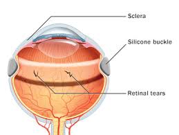 It is a surgical emergency. Retinal Detachment Repair