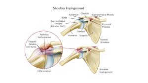 The tendon of the subscapularis muscle attaches both to the lesser tubercle aswell as to the greater tubercle giving support the rotator cuff muscles and tendons act to stabilize the shoulderjoint during movements. Therapia Physiotherapy For Shoulder Pain