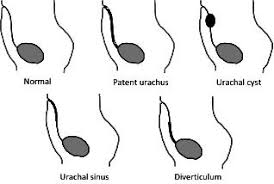 Urachal Abnormalities Ucsf Department Of Urology