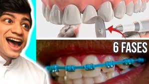 Aparelho Ortodôntico fixo Convencional!Tratamento com a Dra. Carla Galati  #aparelhoortodôntico