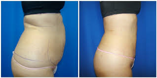 As is true with all surgical procedures, cheaper pretty much never equals better. What Is Lipo 360 Houston Lipo Center