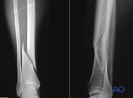 What does spiral fracture mean? Orif Lag Screws Outside Protection Plate For Simple Fracture Spiral