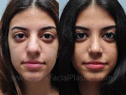 Surgery, including laser treatment or dermabrasion, may be necessary to remove large bumps on the nose from rhinophyma if they interfere with breathing. Rhinoplasty For A Bulbous Tip Wide Nasal Tip Surgery Funk Facial Plastic Surgery